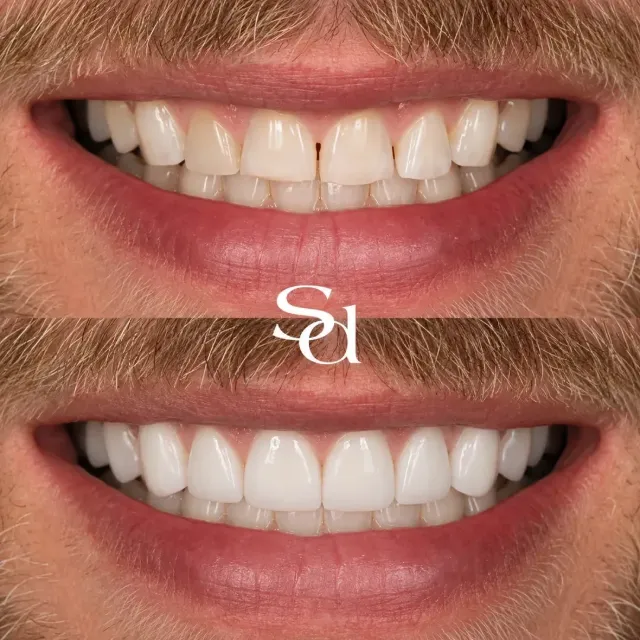 Before and after of a Sale Dental Spa patient treated by Dr Aisha Ahmed