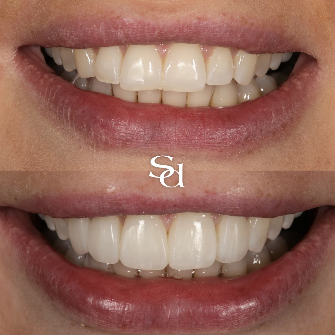 Composite bonding before and after at Sale Dental Spa: front teeth reshaped and brightened with composite bonding, by Dr Hamza Mirza. Un-retouched.