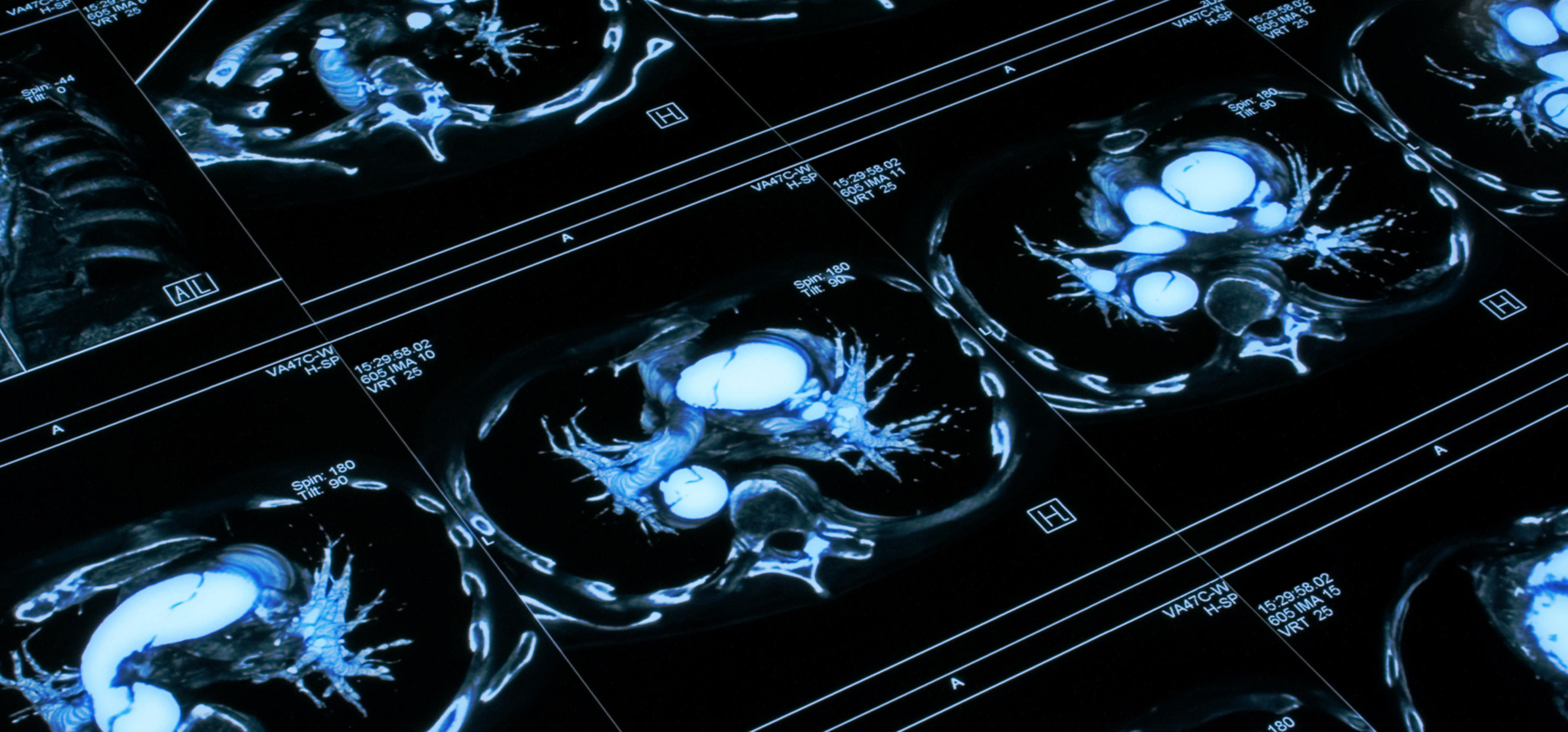 Close-up view of multiple medical CT scan images showing cross-sections of a human chest, highlighting the heart and major blood vessels in blue and white against a black background.