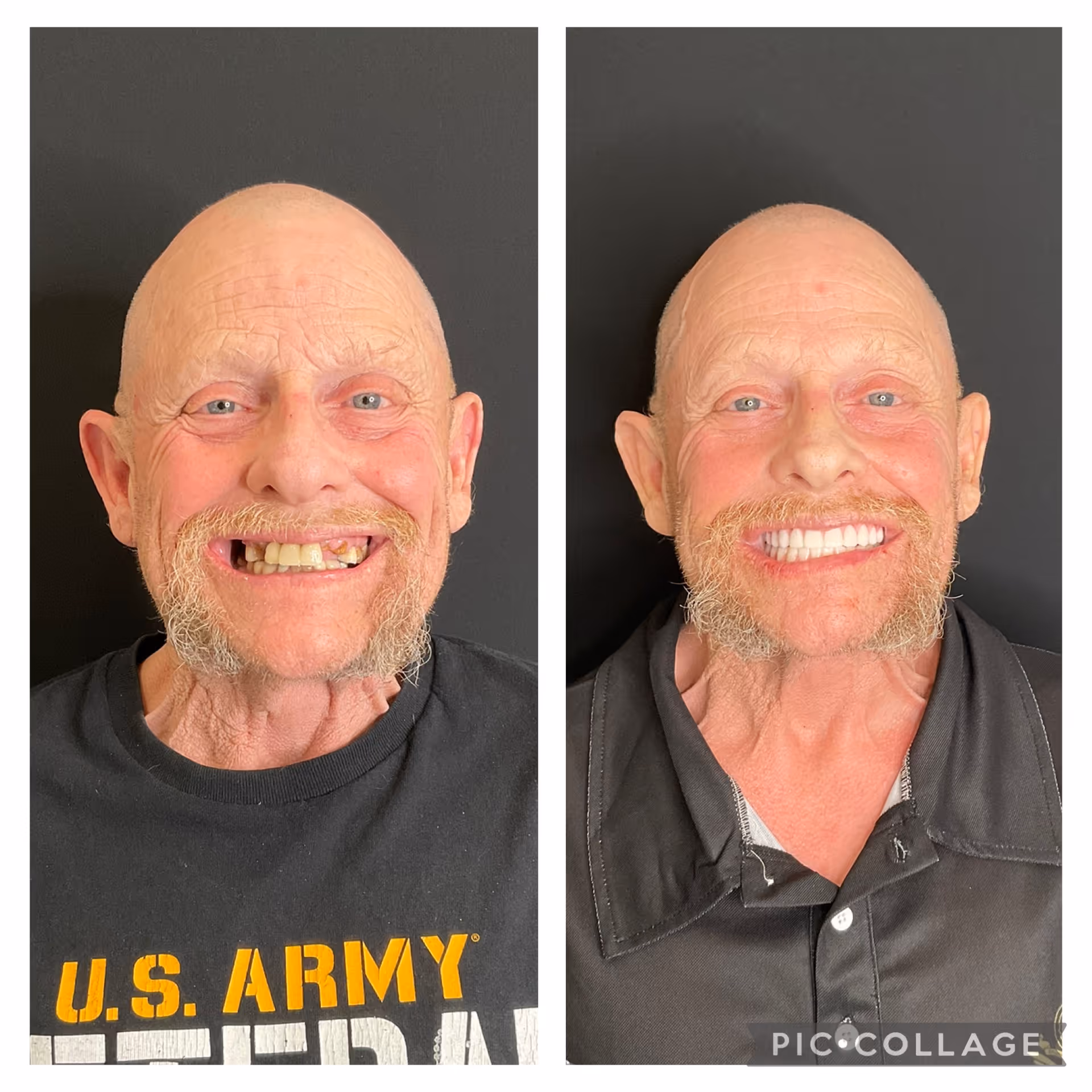 Before and after full-arch dental implant reconstruction at Stone Dental Implant Center