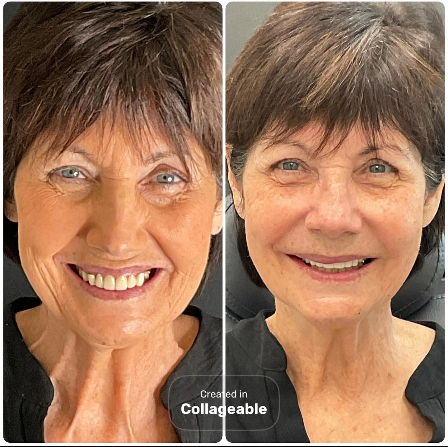 Before and after full-arch dental implant reconstruction at Stone Dental Implant Center