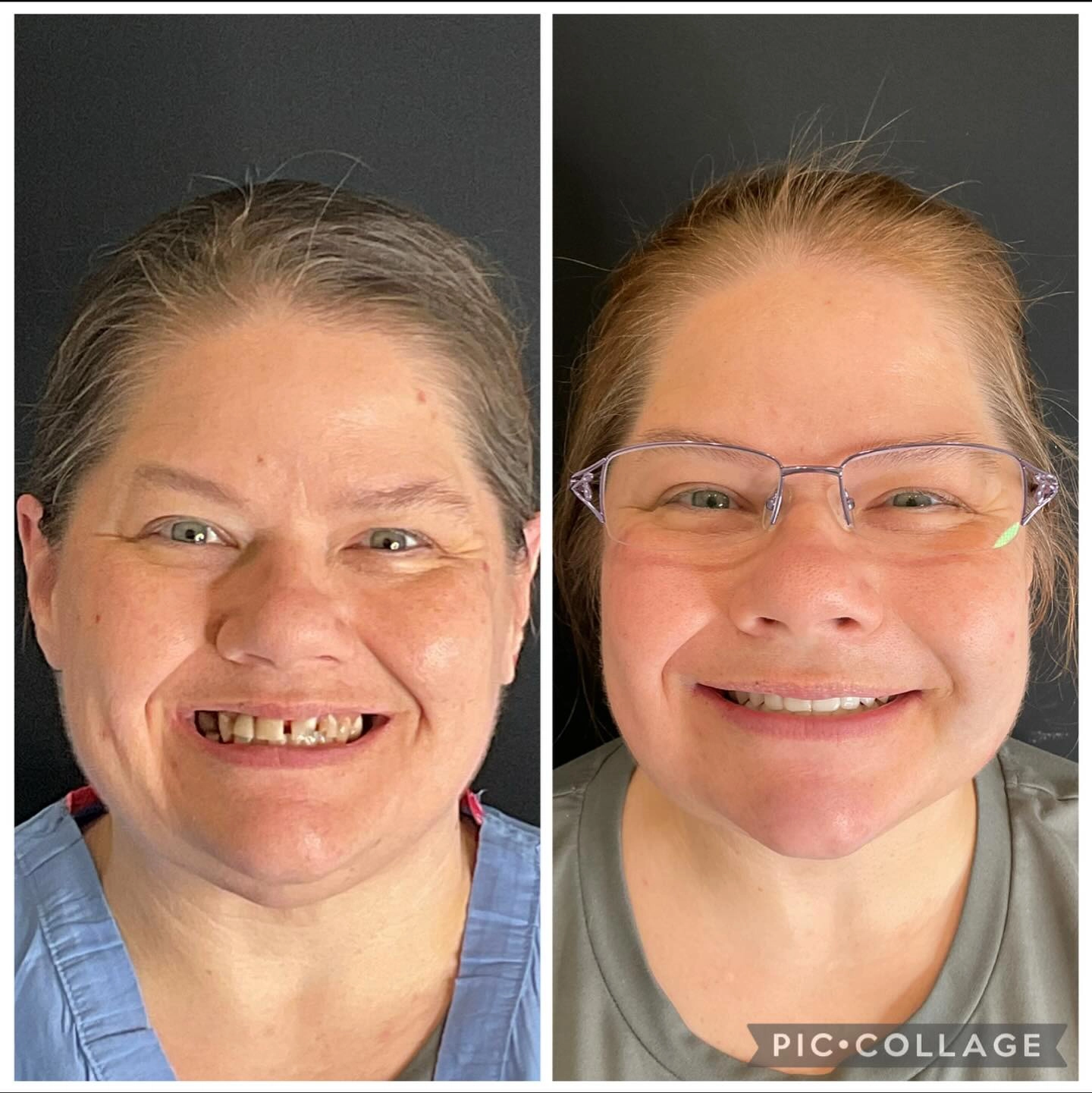 Before and after full-arch dental implant reconstruction at Stone Dental Implant Center