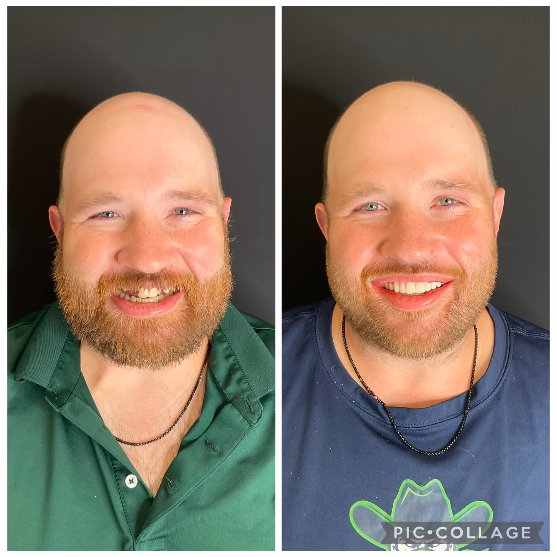 Before and after full-arch dental implant reconstruction at Stone Dental Implant Center