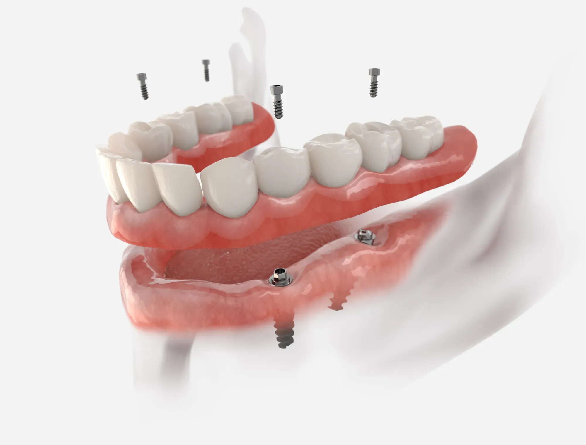 All-on-X dental implants at Stone Dental Implant Center