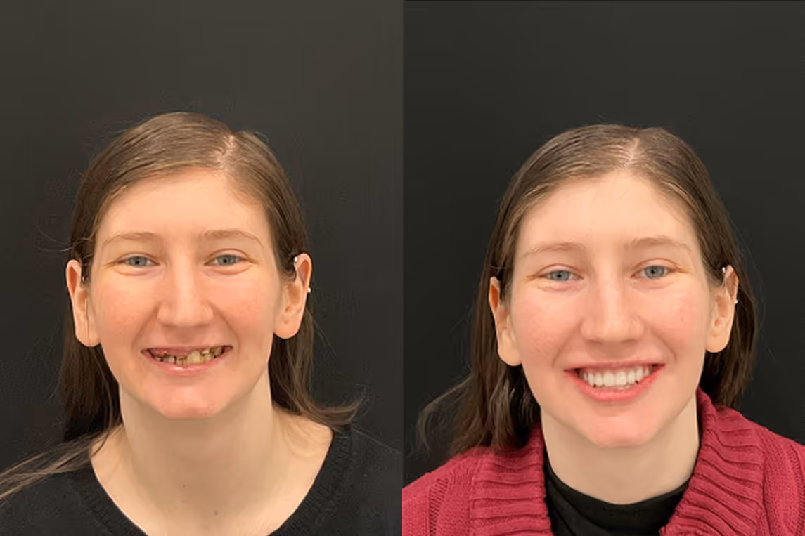 All-on-X implants before and after result at Stone Dental Implant Center