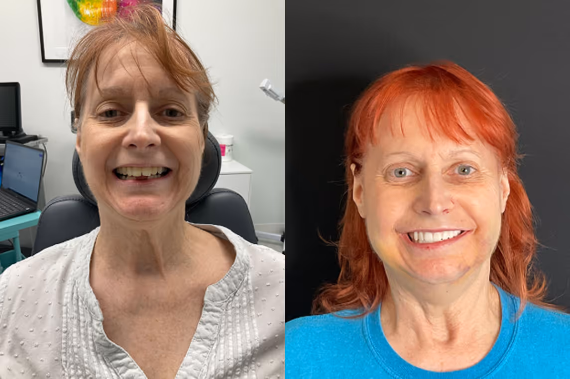 All-on-X implants before and after result at Stone Dental Implant Center