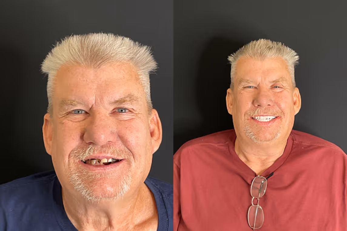 All-on-X implants before and after result at Stone Dental Implant Center