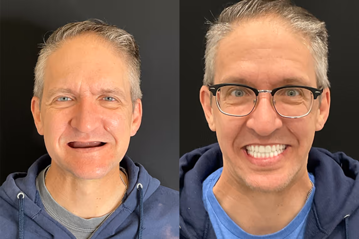 All-on-X implants before and after result at Stone Dental Implant Center