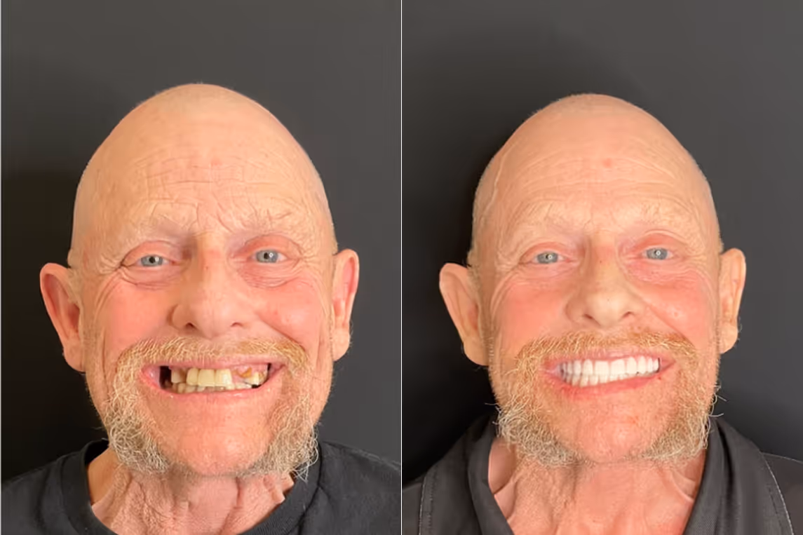 All-on-X implants before and after result at Stone Dental Implant Center