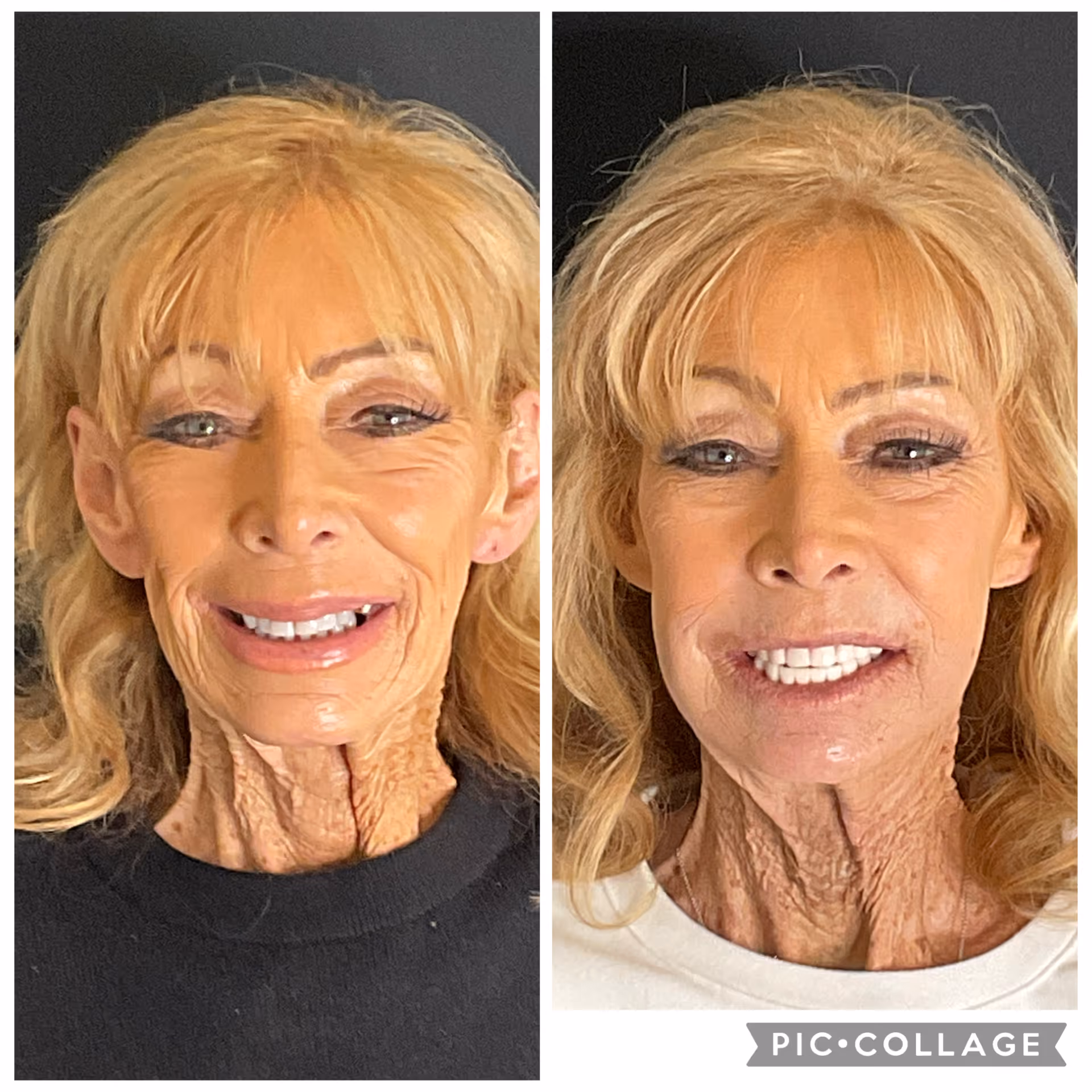 Before and after dental implant result at Stone Dental Implant Center