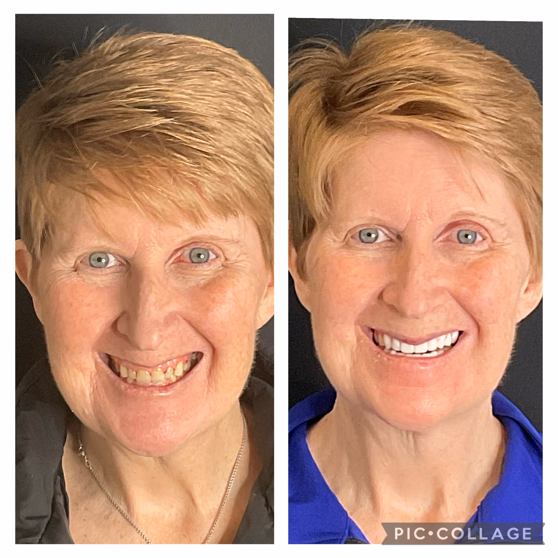 Before and after dental implant result at Stone Dental Implant Center