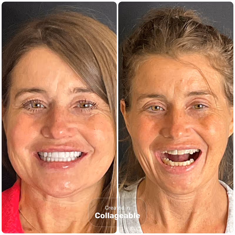 Before and after dental implant result at Stone Dental Implant Center