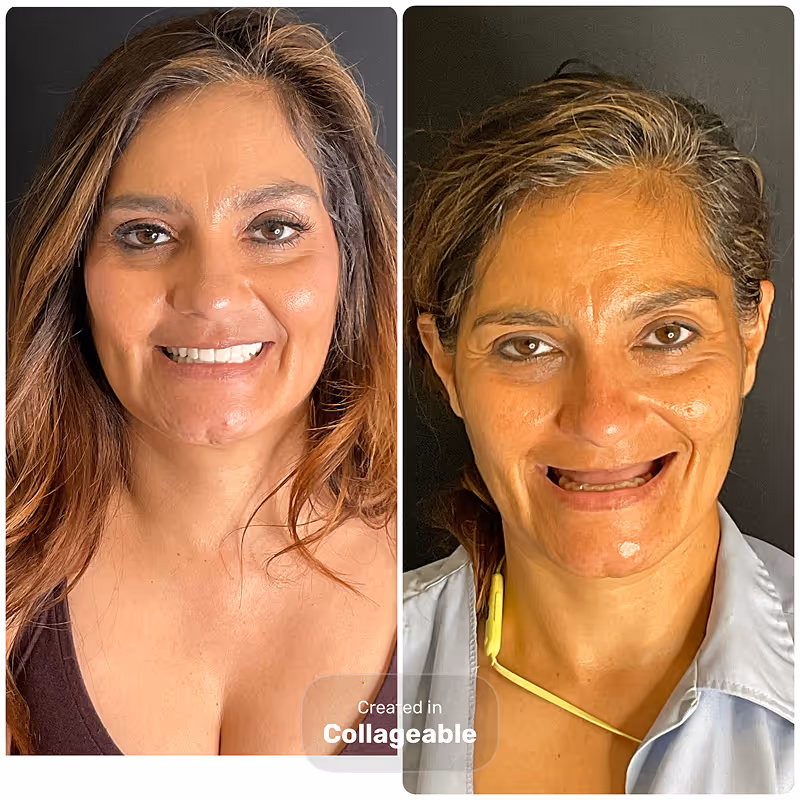 Before and after dental implant result at Stone Dental Implant Center
