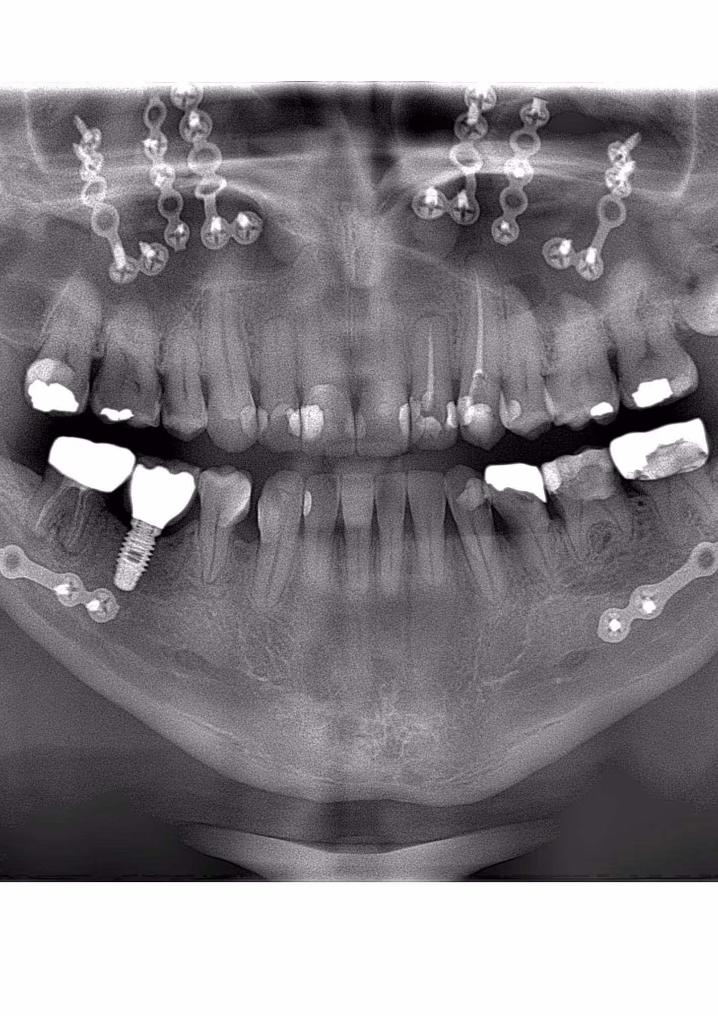Orthognathic surgery repositioning the jaws to correct the bite