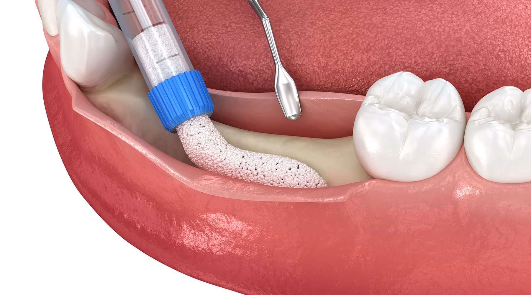 Reshaping the alveolar ridge for a comfortable denture or implant fit