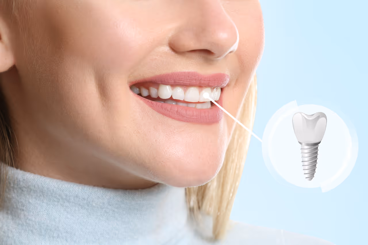 The Dental Implants Process: From Consultation to Final Restoration