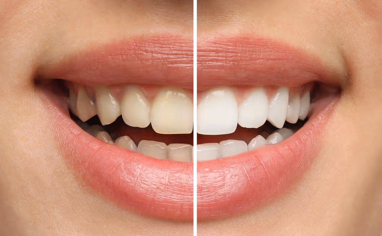 Is Teeth Whitening Right for You? Signs It’s Time to Brighten Your Smile