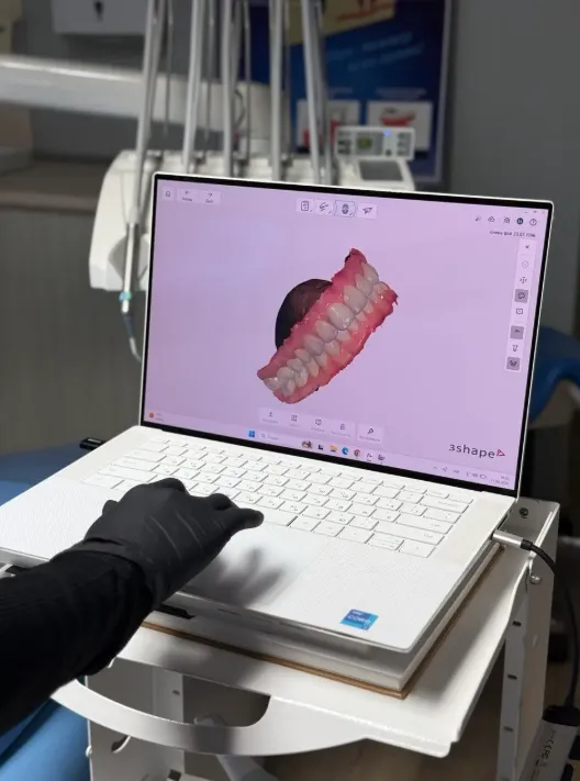 Laptop screen showing a 3D model of teeth with a gloved hand near the keyboard in a dental setting.