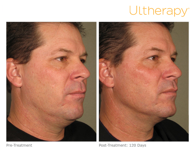 Comparativa clínica de Ultherapy® en vista facial oblicua: antes y 120 días después