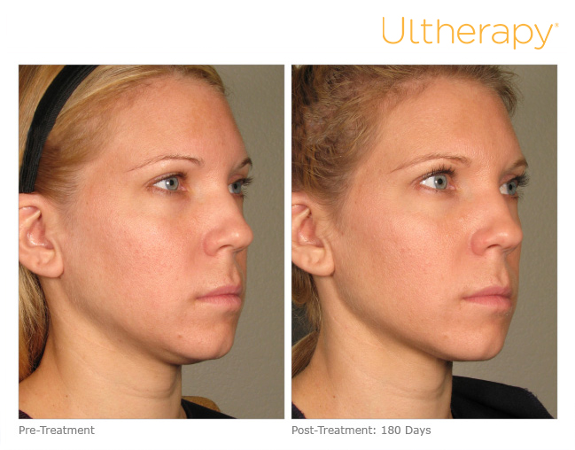 Comparativa clínica de Ultherapy® en vista facial oblicua: antes y 180 días después