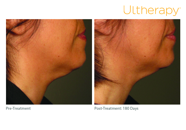 Segundo caso clínico de Ultherapy® en región submentoniana y cuello: antes y 180 días después