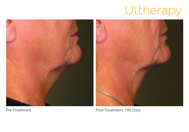 Comparativa clínica de Ultherapy® en región submentoniana y cuello: antes y 180 días después