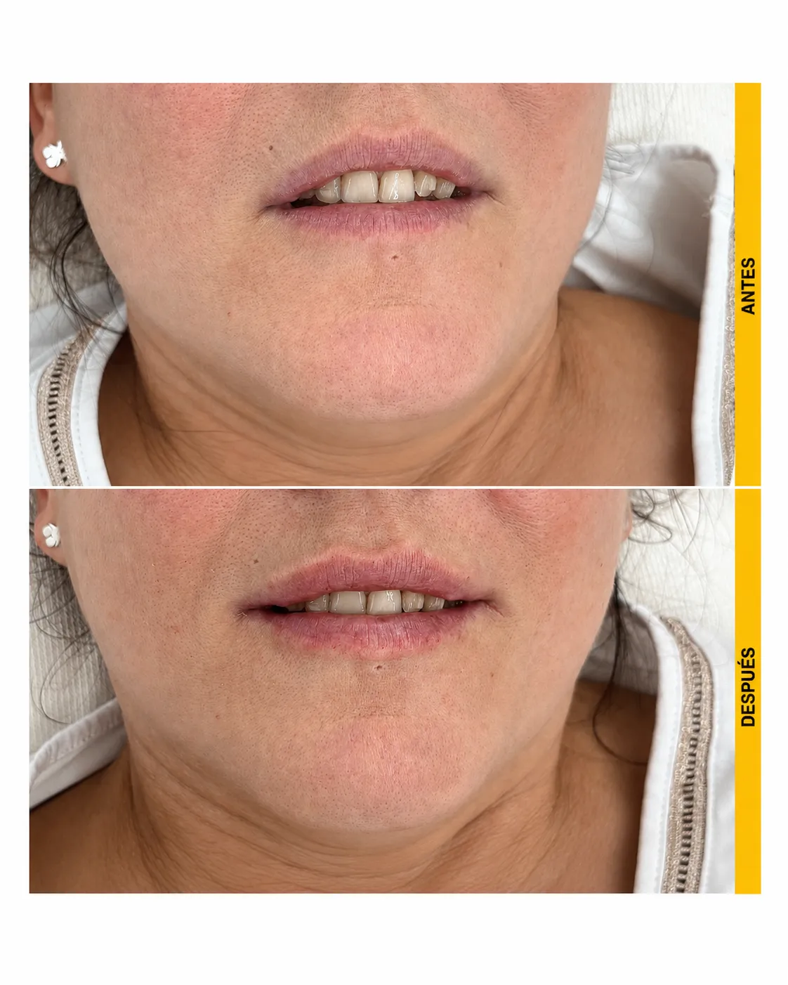 Comparación antes y después de armonización labial, vista frontal
