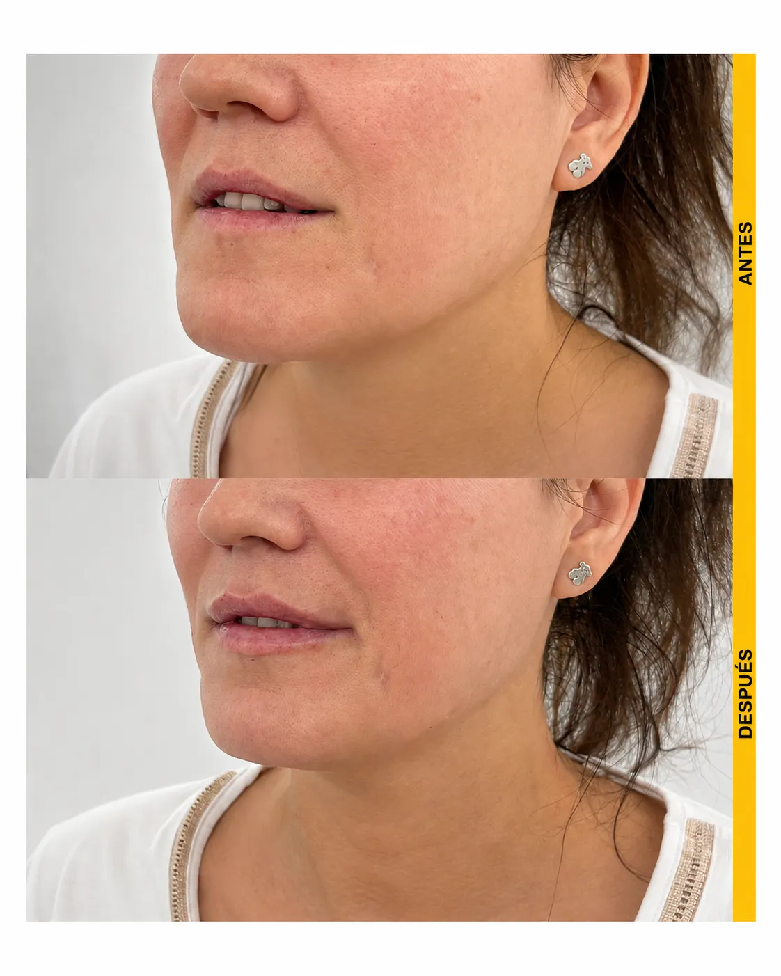 Comparación antes y después de armonización labial, vista lateral izquierda