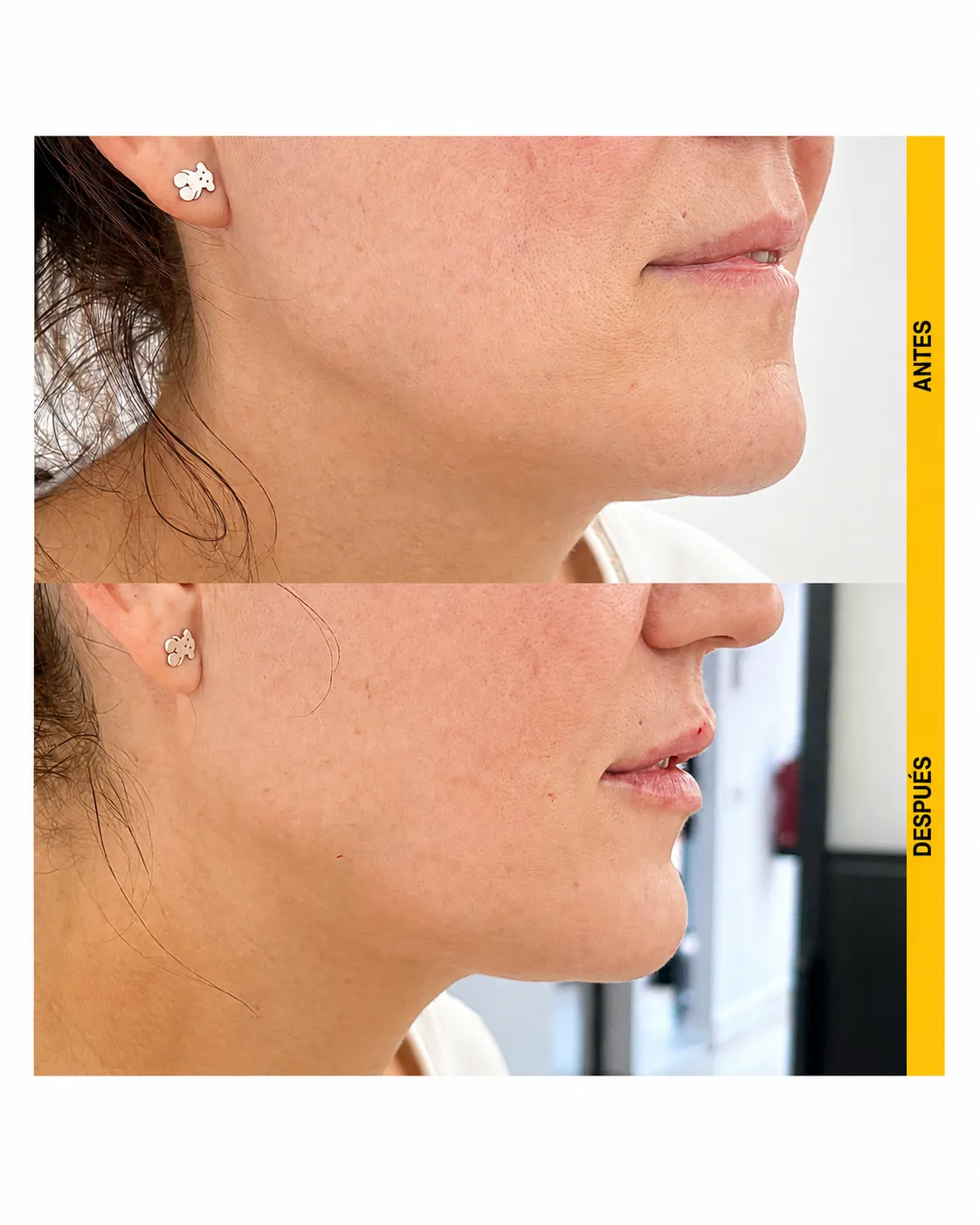 Comparación antes y después de armonización labial, vista lateral derecha