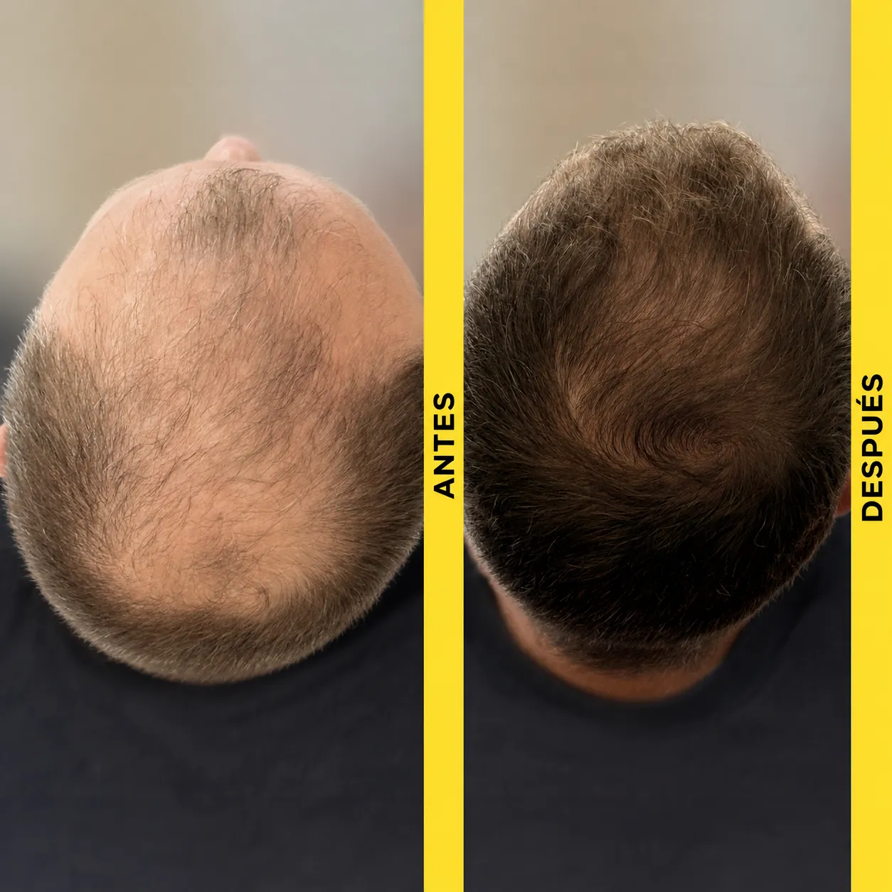 Alopecia androgenética: antes del tratamiento y evolución a doce meses