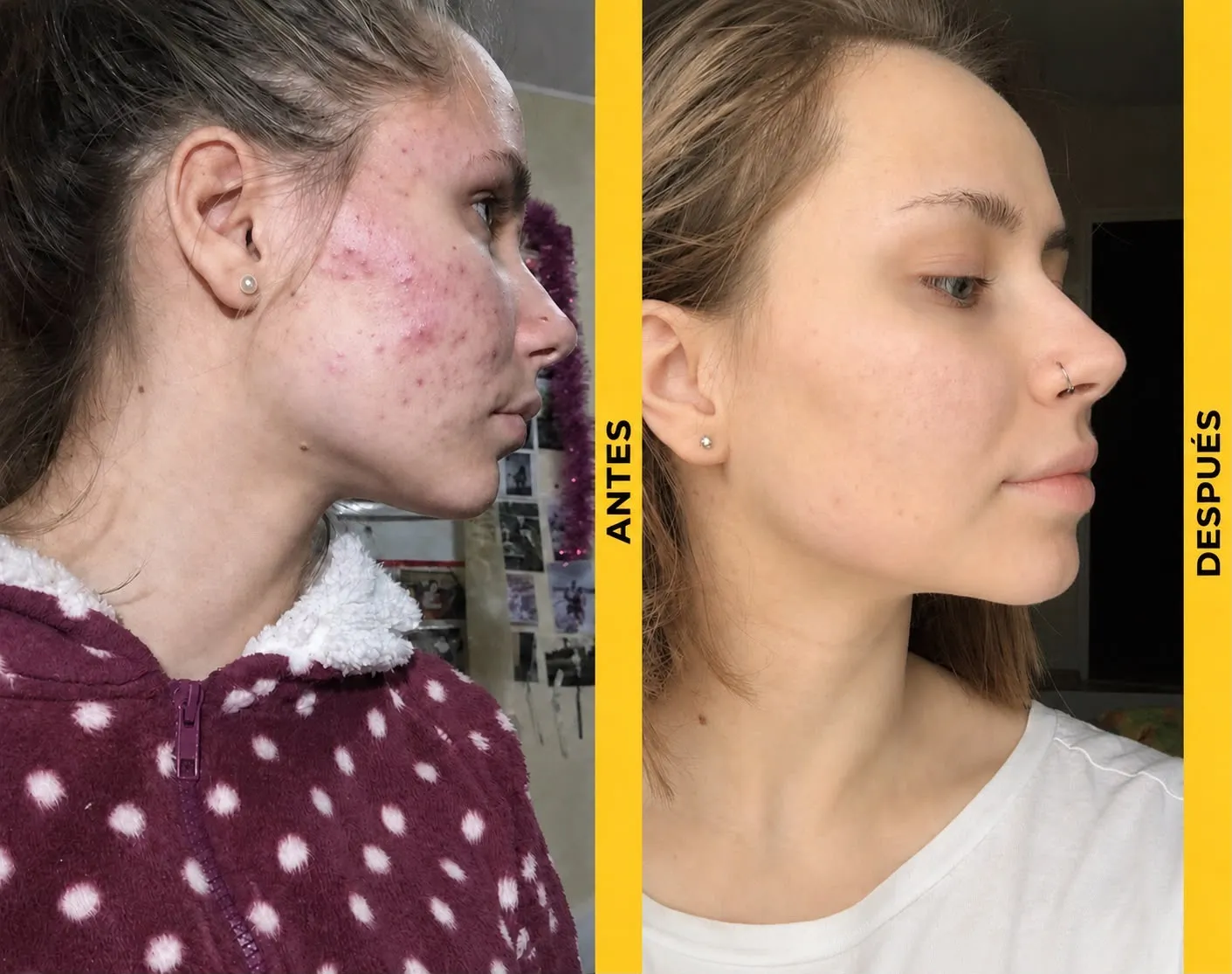 Acné moderado: antes del tratamiento y evolución a los seis meses