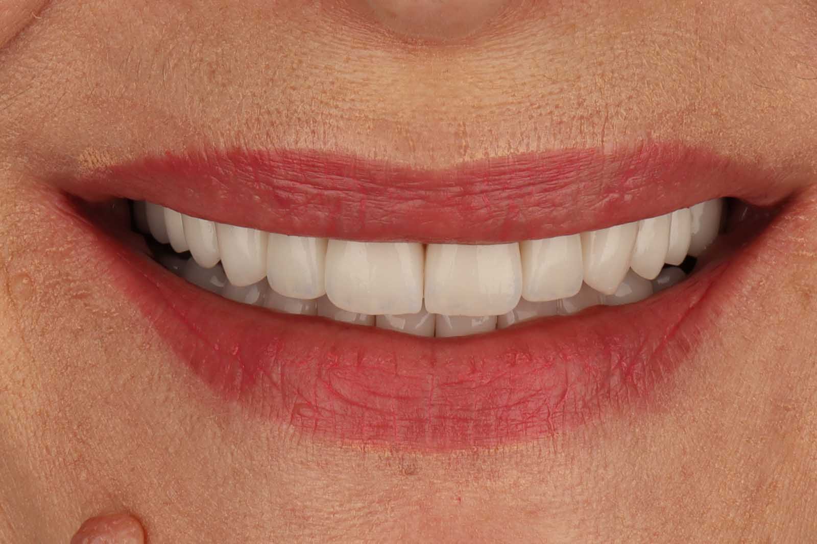 Osmijeh pacijenta nakon tretmana u TB Dent ordinaciji u Trebinju