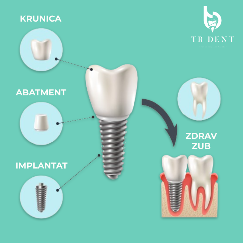 zubni implantati proces trebinje