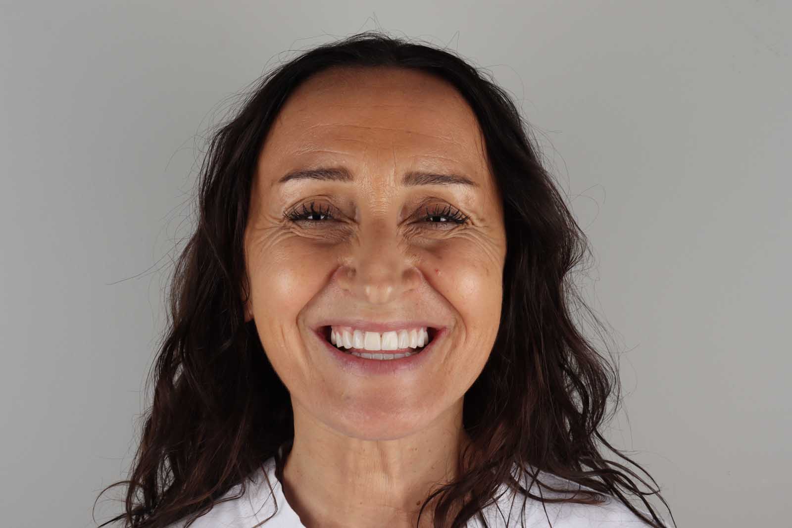 Poslije tretmana Hollywood Smile — pacijent 7, TB Dent Trebinje