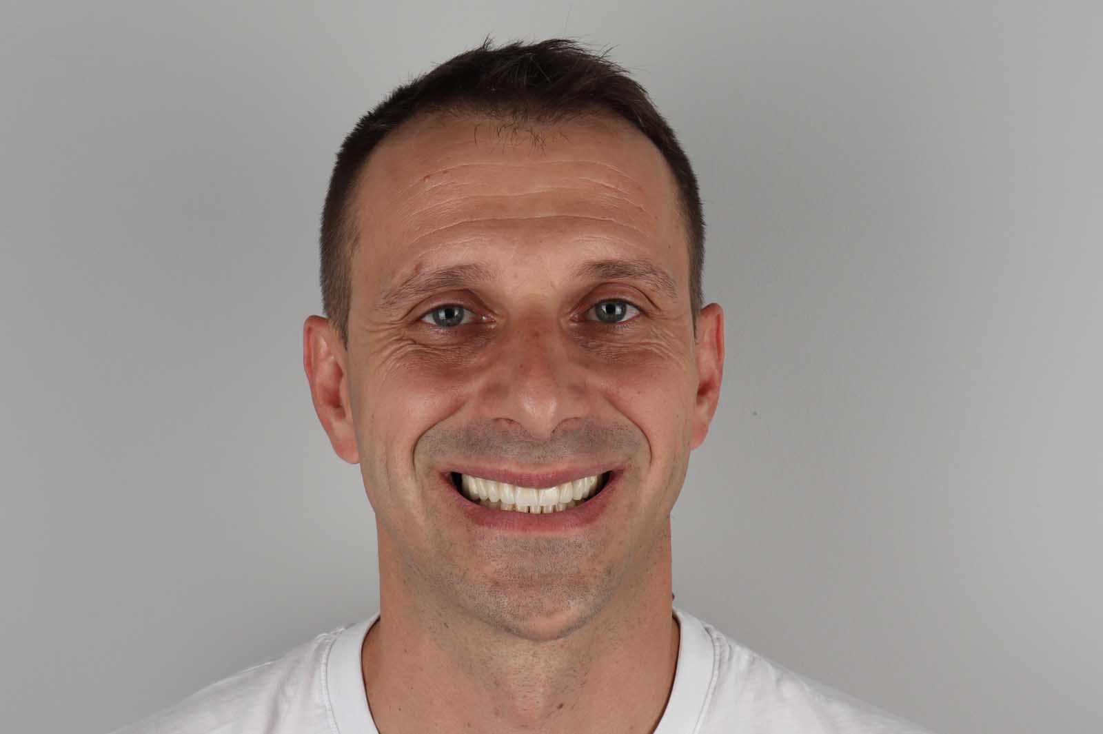 Poslije tretmana Hollywood Smile — pacijent 6, TB Dent Trebinje