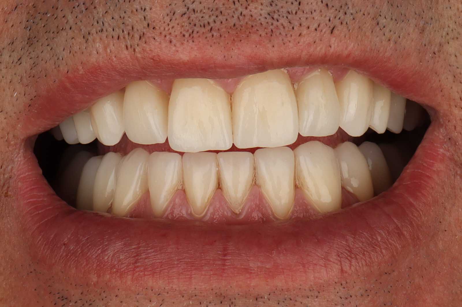 Slučaj 03 poslije tretmana (Hollywood Smile — cirkonske krunice) — TB Dent Trebinje