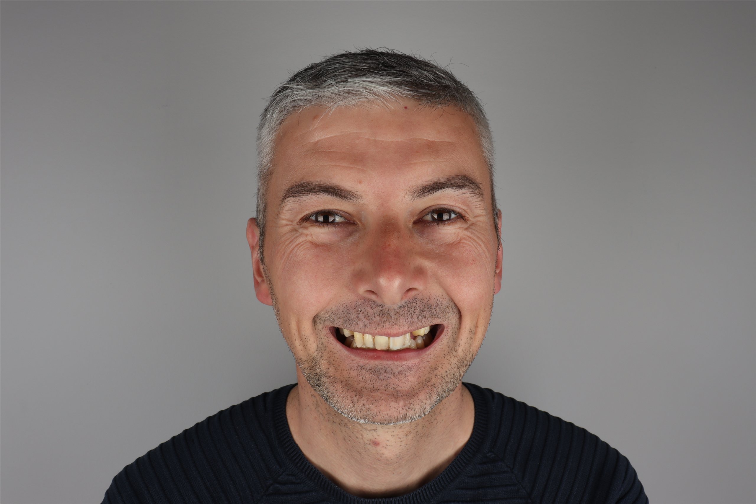 Prije tretmana Hollywood Smile — pacijent 3, TB Dent Trebinje