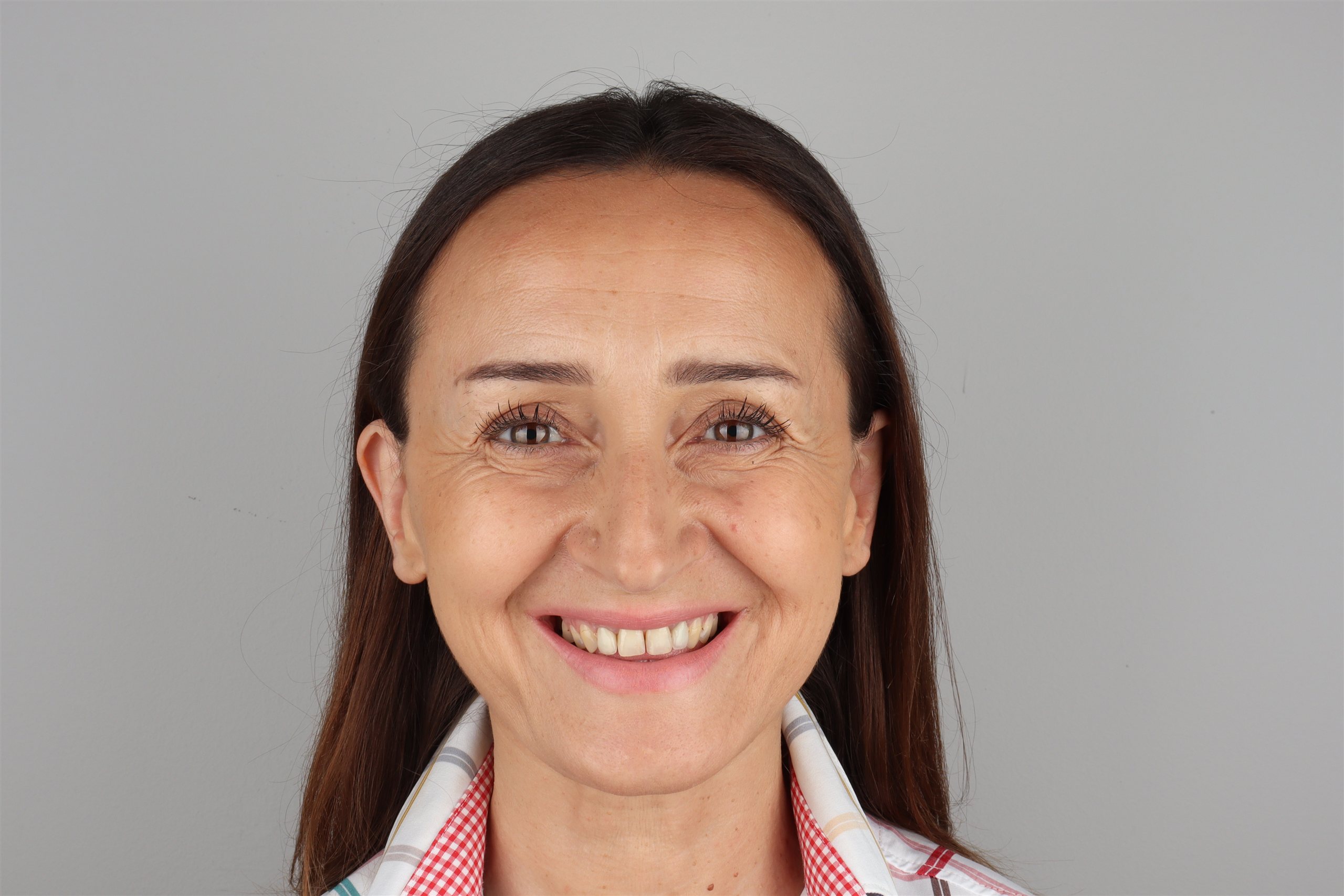 Prije tretmana Hollywood Smile — pacijent 7, TB Dent Trebinje