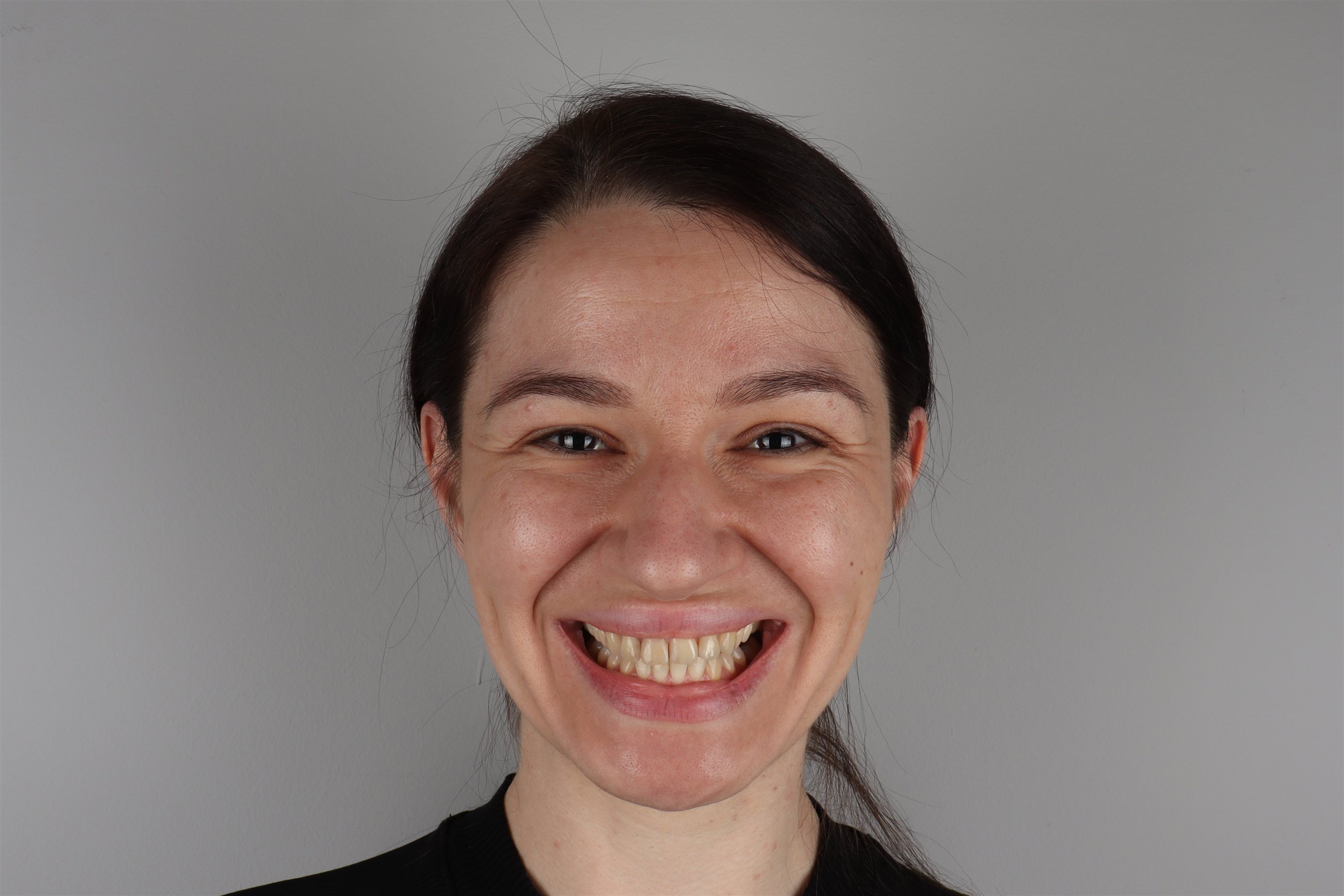 Prije tretmana Hollywood Smile — pacijent 5, TB Dent Trebinje