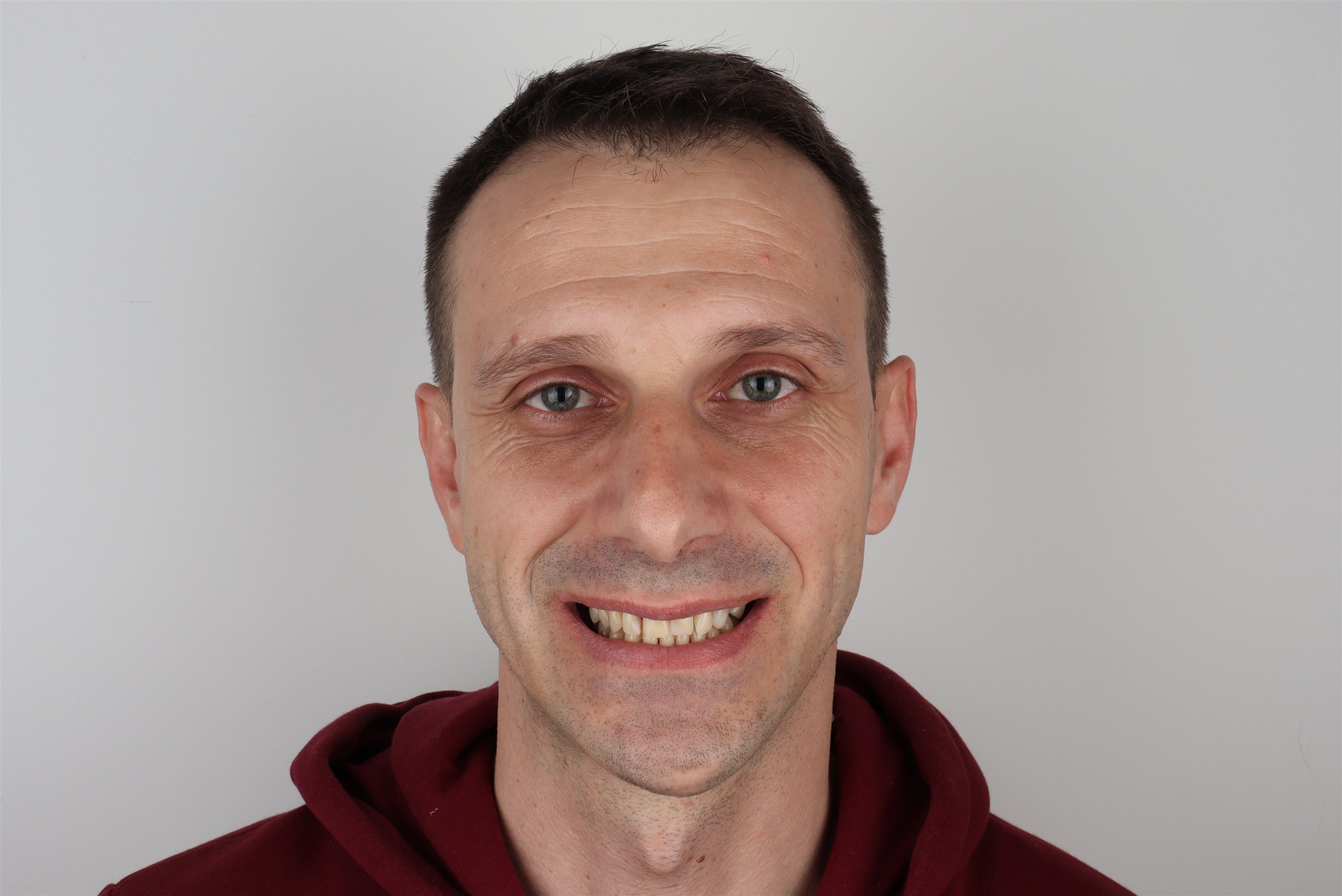 Prije tretmana Hollywood Smile — pacijent 6, TB Dent Trebinje