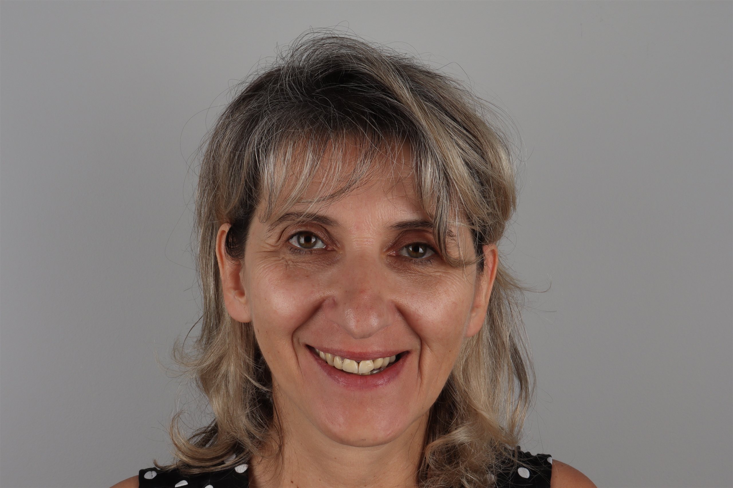 Prije tretmana Hollywood Smile — pacijent 1, TB Dent Trebinje