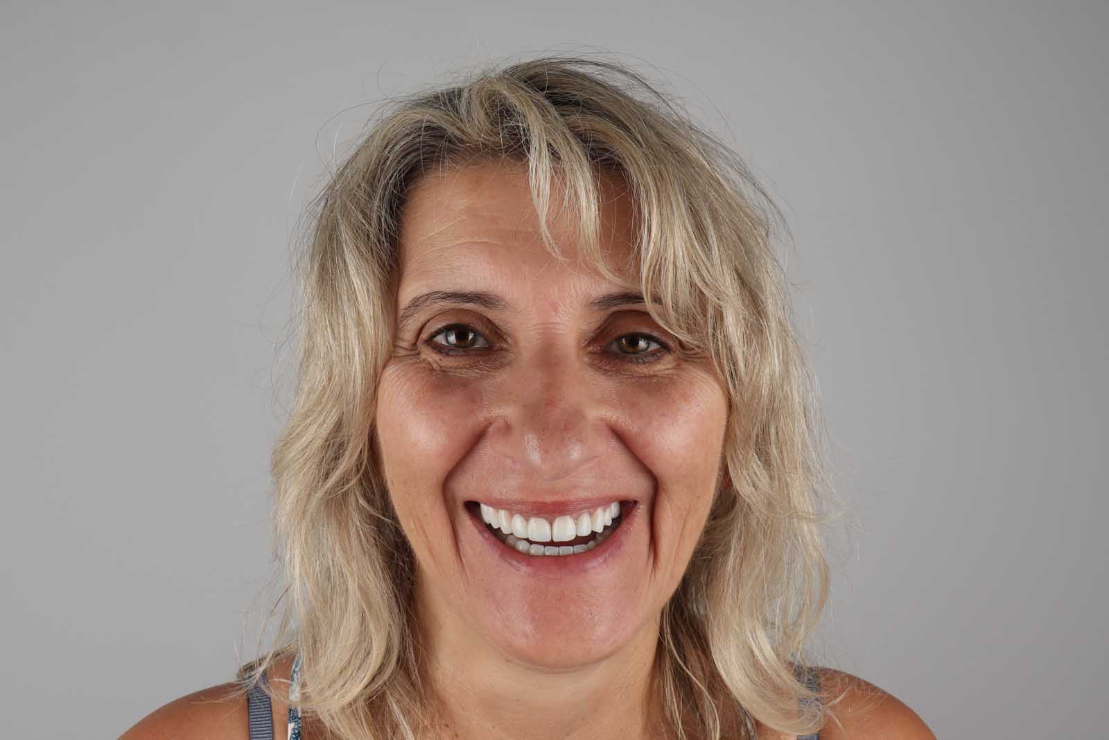 Poslije tretmana Hollywood Smile — pacijent 1, TB Dent Trebinje