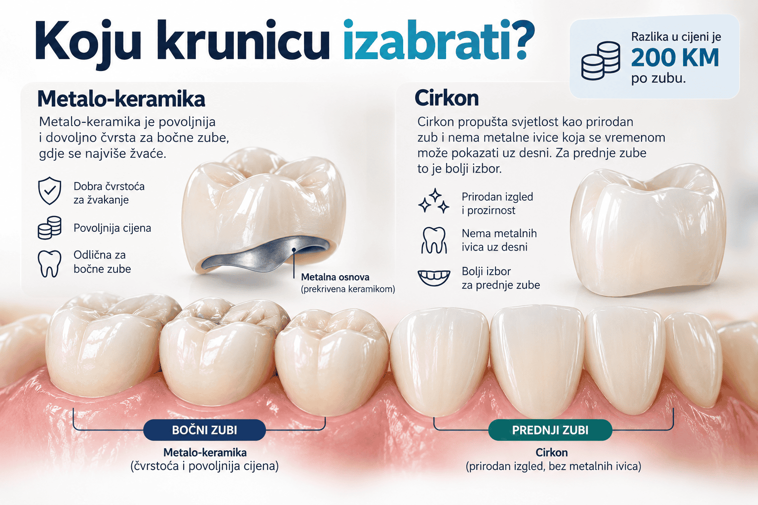 Metalo-keramička i cirkon krunica – poređenje krunica za bočne i prednje zube