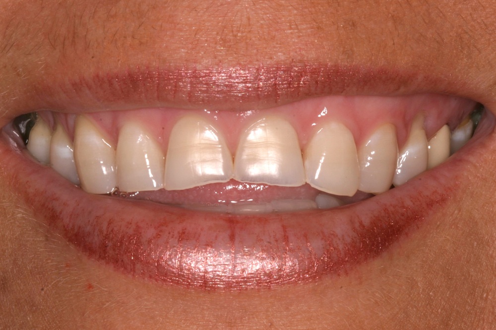 Before Image