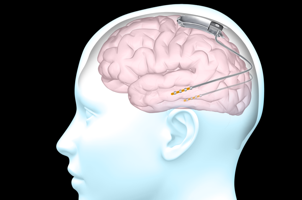 3D diagram depicting a human brain within a human head with a small metal RNS device resting atop the back half of the brain.