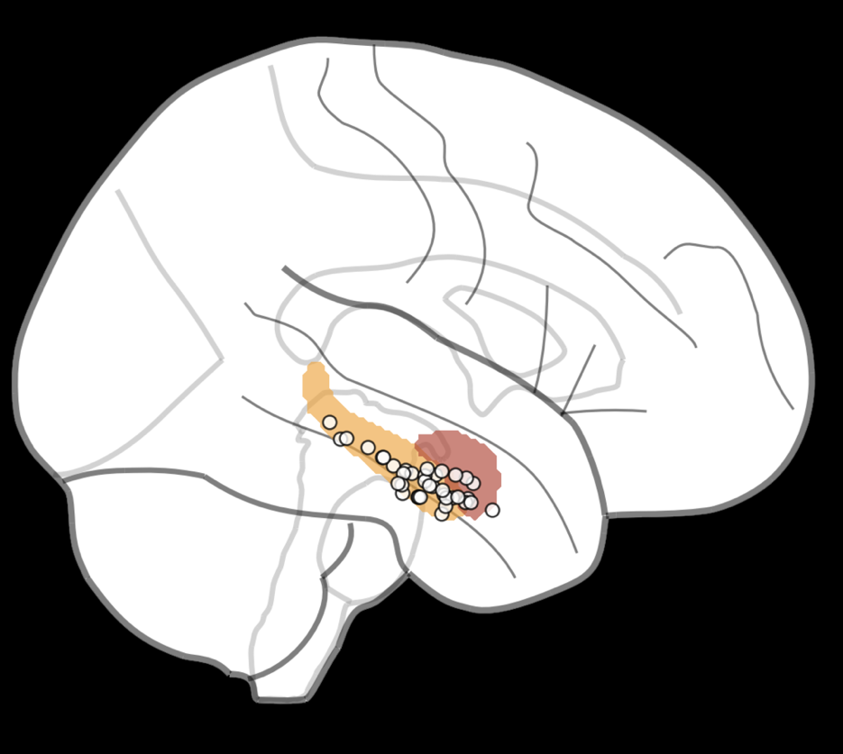 Line-style diagram depicting an electrode within a human brain, viewed from the side.