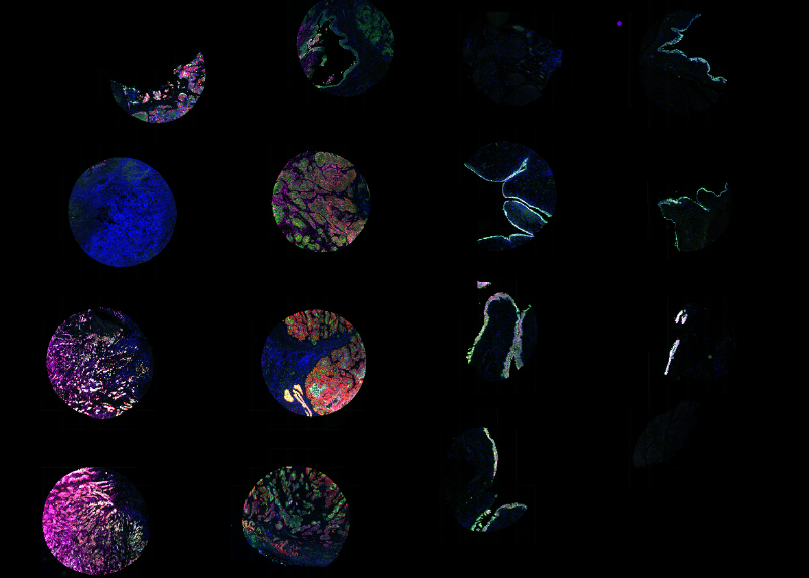 Multiplex immunofluorescence image of a TMA consisting of human healthy bladder tissue and human urothelial carcinoma tissue stained with Revolune Illuminate-P4-R (DAPI-blue, EGFR-red, HER2-cyan, Nectin4-pink, TROP2-green)