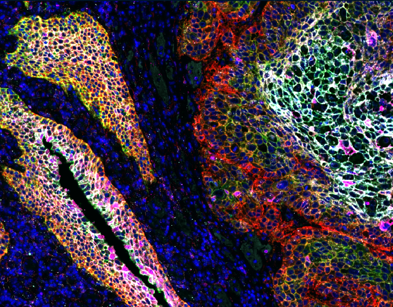 Multiplex immunofluorescence image of human bladder tissue stained with Revolune Illuminate-P4-R (DAPI-blue, EGFR-red, HER2-cyan, Nectin4-pink, TROP2-green)