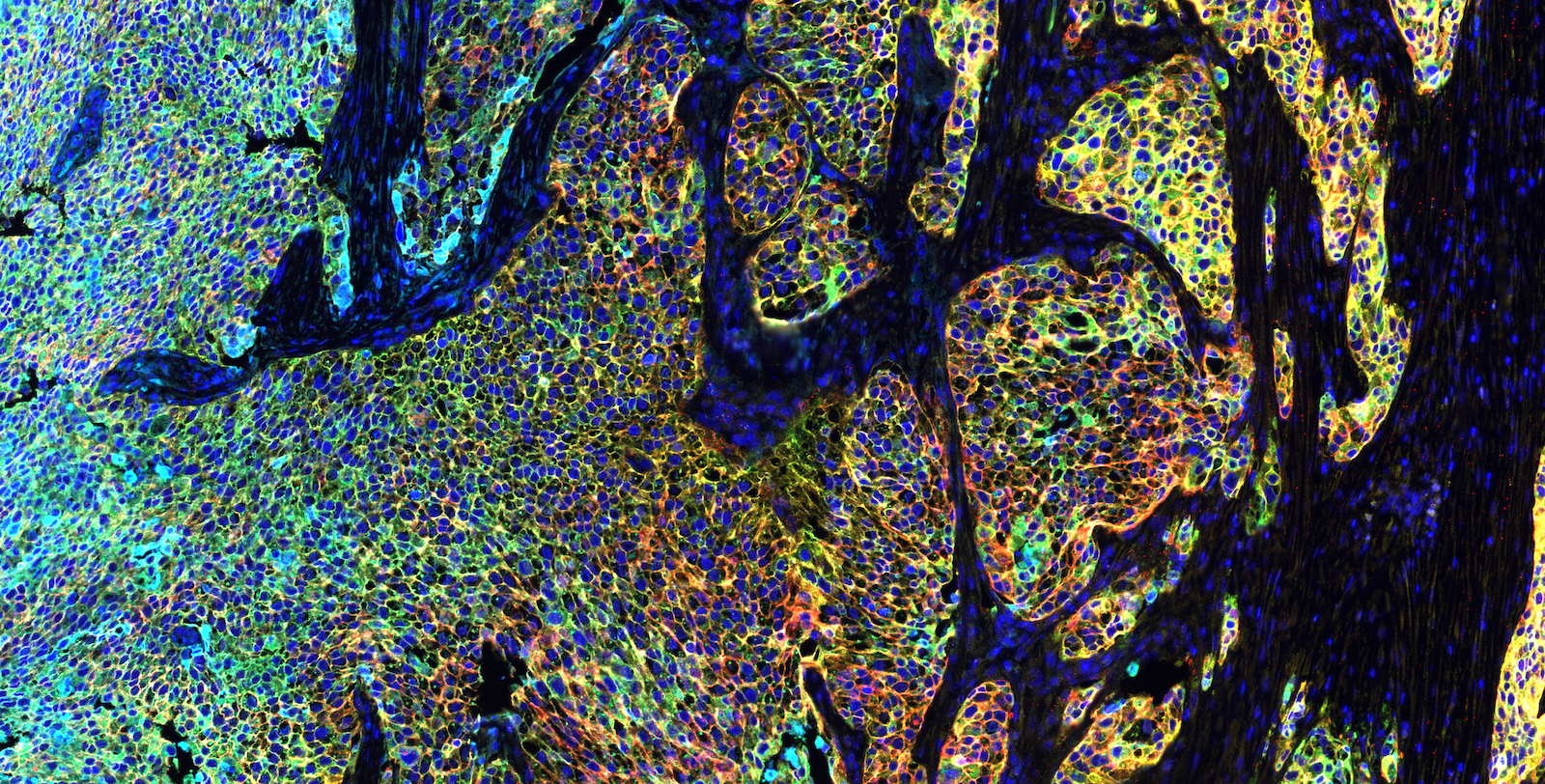 Multiplex immunofluorescence image of human urothelial carcinoma stained with Revolune Illuminate-P4-R (DAPI-blue, TROP2-green, HER2-red, EGFR-yellow, Nectin4-cyan)