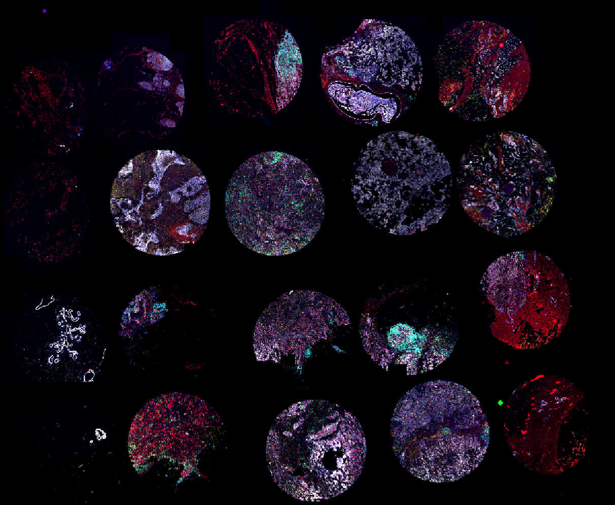 Multiplex immunofluorescence image of TMA consisting of human healthy breast tissue and breast adenocarcinoma tissue stained with Revolune Illuminate-P4-R (DAPI-blue, Ki67-red, ATP1A1-white, CD68-yellow, CD3-green)